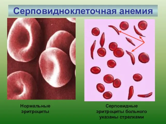 Серповидноклеточная анемия Нормальные эритроциты Серповидные эритроциты больного указаны стрелками