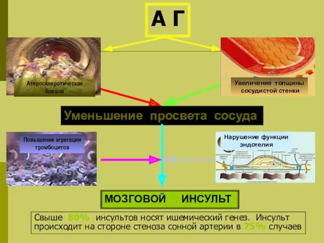 Уменьшение просвета сосуда МОЗГОВОЙ ИНСУЛЬТ Свыше 80% инсультов носят ишемический