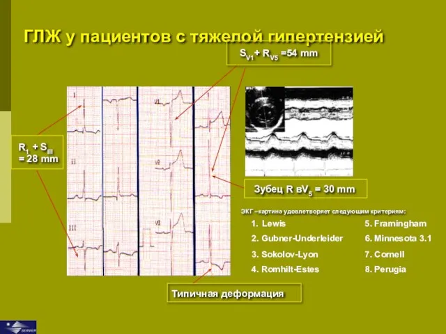 ГЛЖ у пациентов с тяжелой гипертензией SV1+ RV5 =54 mm