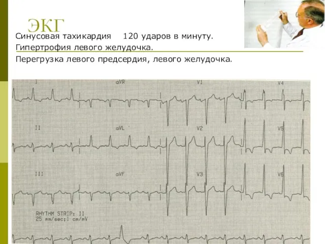 ЭКГ Синусовая тахикардия 120 ударов в минуту. Гипертрофия левого желудочка. Перегрузка левого предсердия, левого желудочка.