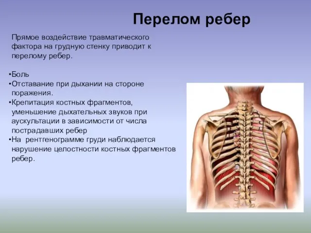 Прямое воздействие травматического фактора на грудную стенку приводит к перелому