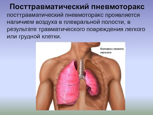 Посттравматический пневмоторакс посттравматический пневмоторакс проявляется наличием воздуха в плевральной полости,