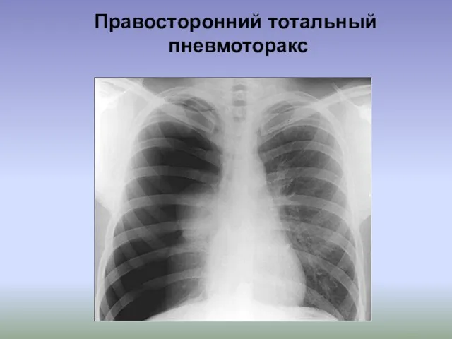 Правосторонний тотальный пневмоторакс