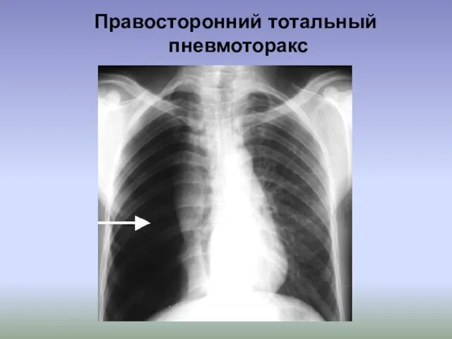 Правосторонний тотальный пневмоторакс