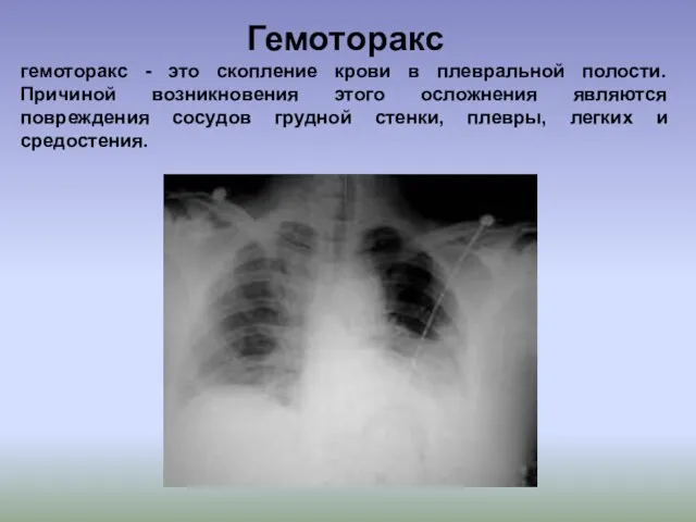 Гемоторакс гемоторакс - это скопление крови в плевральной полости. Причиной