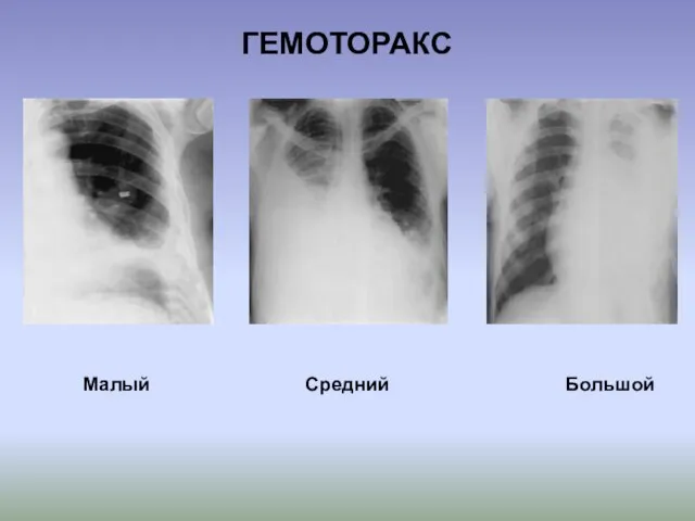 Малый Средний Большой ГЕМОТОРАКС