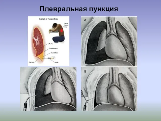 Плевральная пункция