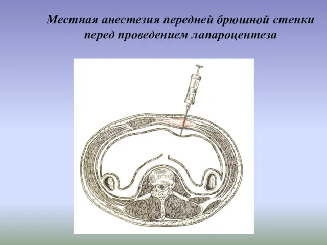 Местная анестезия передней брюшной стенки перед проведением лапароцентеза