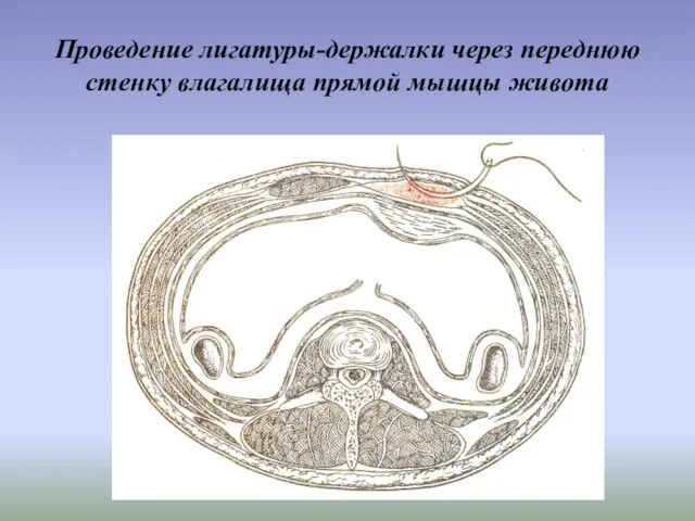 Проведение лигатуры-держалки через переднюю стенку влагалища прямой мышцы живота