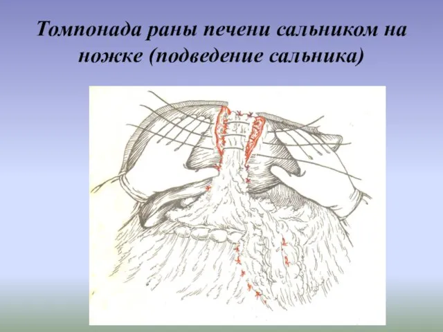 Томпонада раны печени сальником на ножке (подведение сальника)