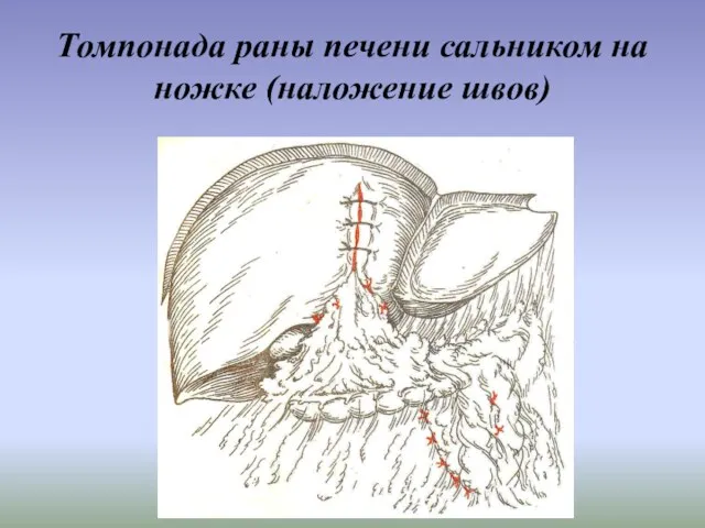 Томпонада раны печени сальником на ножке (наложение швов)