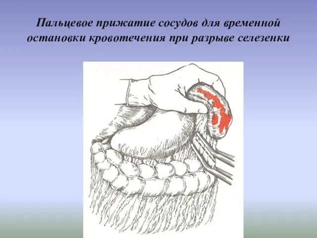 Пальцевое прижатие сосудов для временной остановки кровотечения при разрыве селезенки