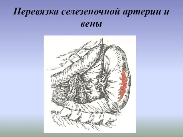 Перевязка селезеночной артерии и вены