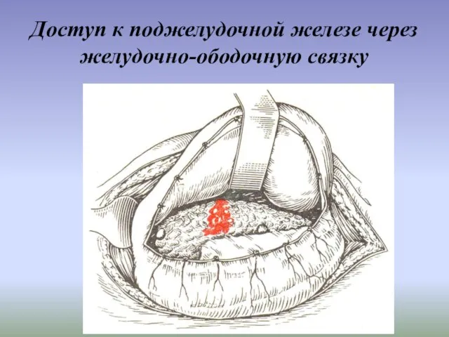 Доступ к поджелудочной железе через желудочно-ободочную связку