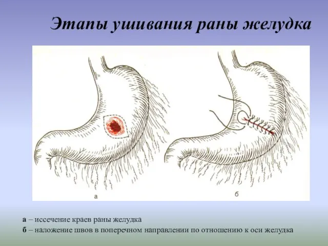 Этапы ушивания раны желудка а – иссечение краев раны желудка