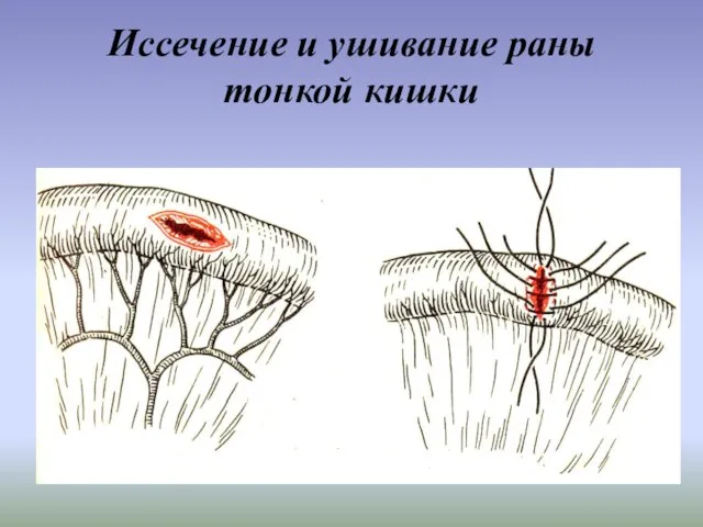 Иссечение и ушивание раны тонкой кишки