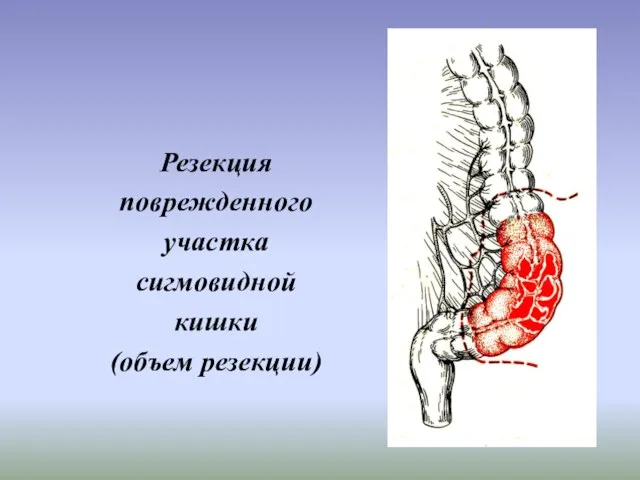 Резекция поврежденного участка сигмовидной кишки (объем резекции)