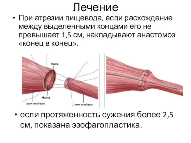 Лечение При атрезии пищевода, если расхождение между выделенными концами его