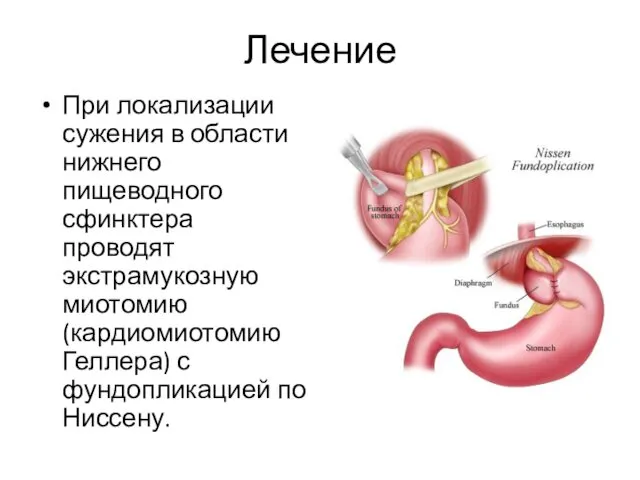 Лечение При локализации сужения в области нижнего пищеводного сфинктера проводят экстрамукозную миотомию (кардиомиотомию