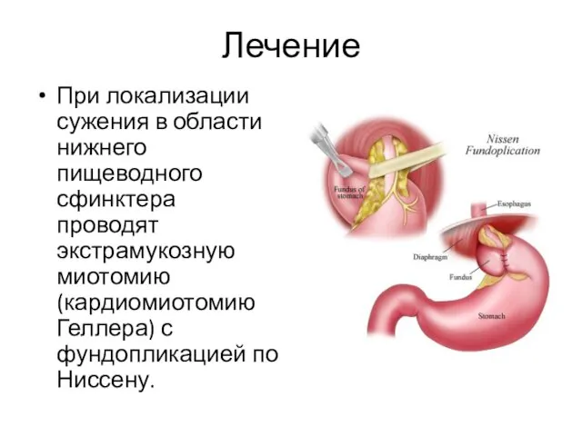 Лечение При локализации сужения в области нижнего пищеводного сфинктера проводят