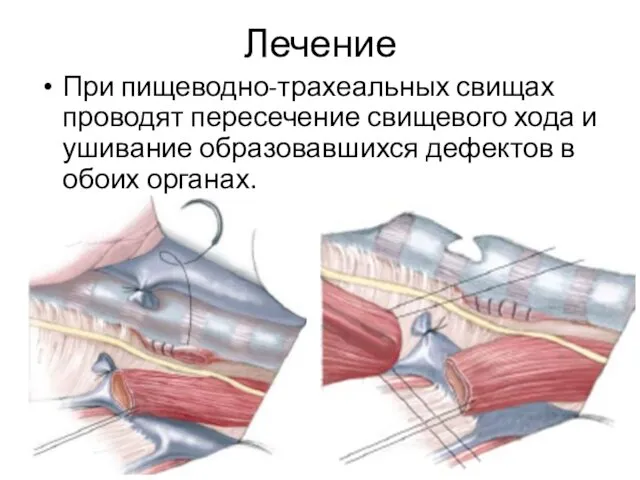 Лечение При пищеводно-трахеальных свищах проводят пересечение свищевого хода и ушивание образовавшихся дефектов в обоих органах.