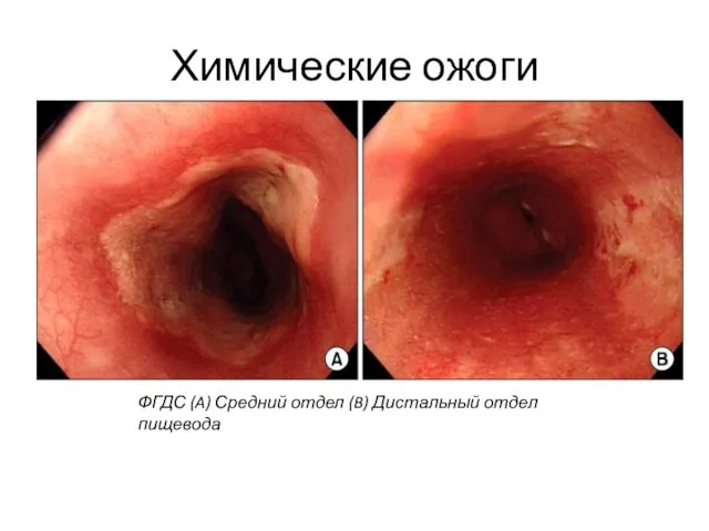 Химические ожоги ФГДС (A) Средний отдел (B) Дистальный отдел пищевода