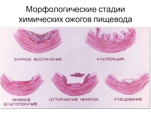 Морфологические стадии химических ожогов пищевода