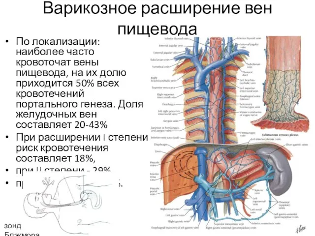 Варикозное расширение вен пищевода По локализации: наиболее часто кровоточат вены