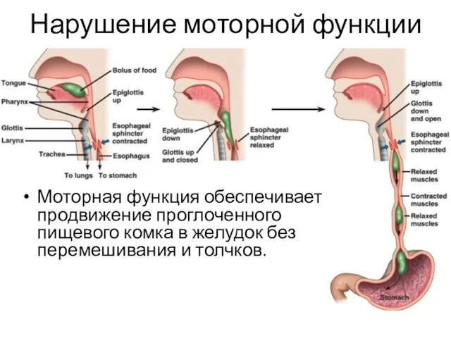 Нарушение моторной функции Моторная функция обеспечивает продвижение проглоченного пищевого комка в желудок без перемешивания и толчков.