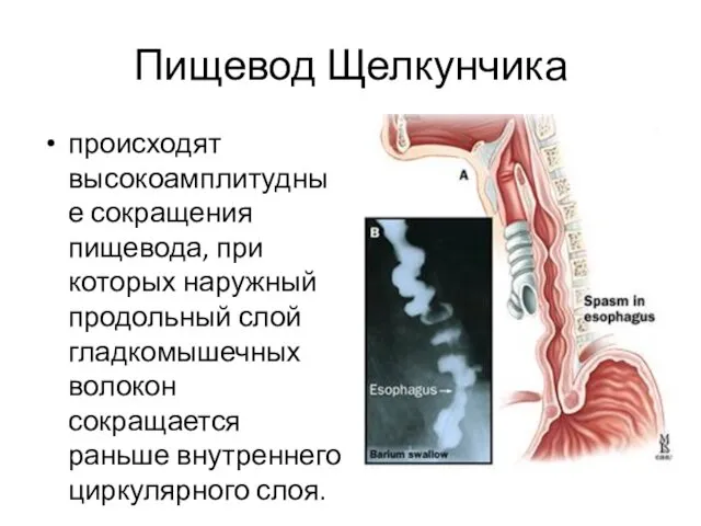 Пищевод Щелкунчика происходят высокоамплитудные сокращения пищевода, при которых наружный продольный