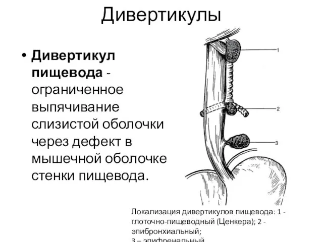 Дивертикулы Дивертикул пищевода - ограниченное выпячивание слизистой оболочки через дефект