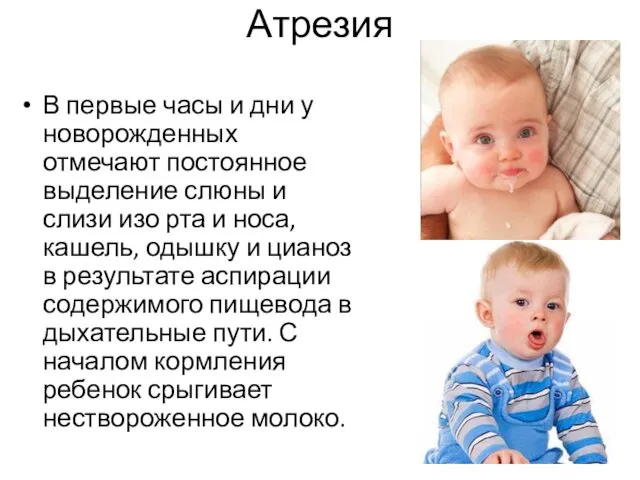 Атрезия В первые часы и дни у новорожденных отмечают постоянное выделение слюны и