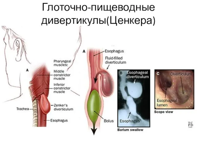 Глоточно-пищеводные дивертикулы(Ценкера)