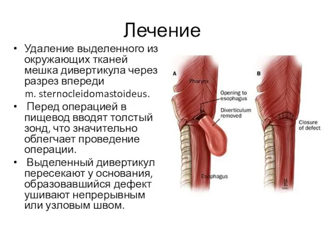 Лечение Удаление выделенного из окружающих тканей мешка дивертикула через разрез