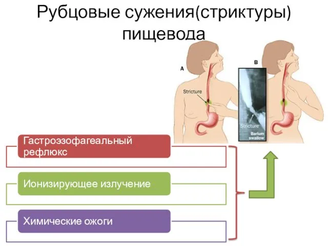 Рубцовые сужения(стриктуры) пищевода