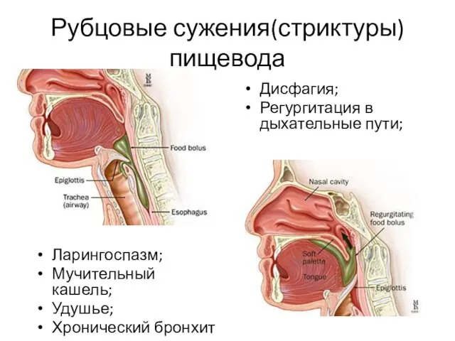 Рубцовые сужения(стриктуры) пищевода Ларингоспазм; Мучительный кашель; Удушье; Хронический бронхит Дисфагия; Регургитация в дыхательные пути;