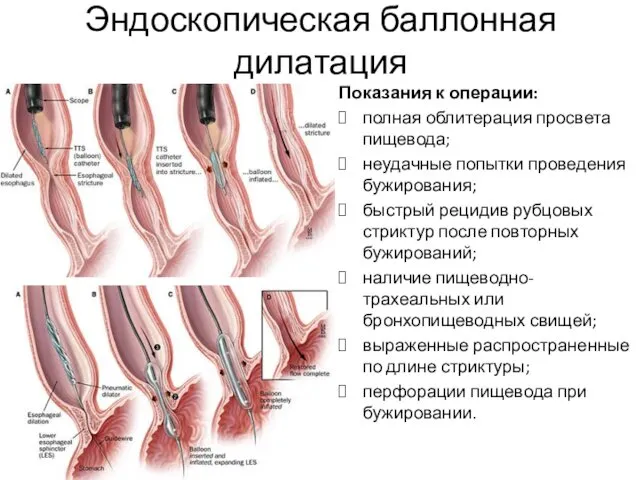 Эндоскопическая баллонная дилатация Показания к операции: полная облитерация просвета пищевода;