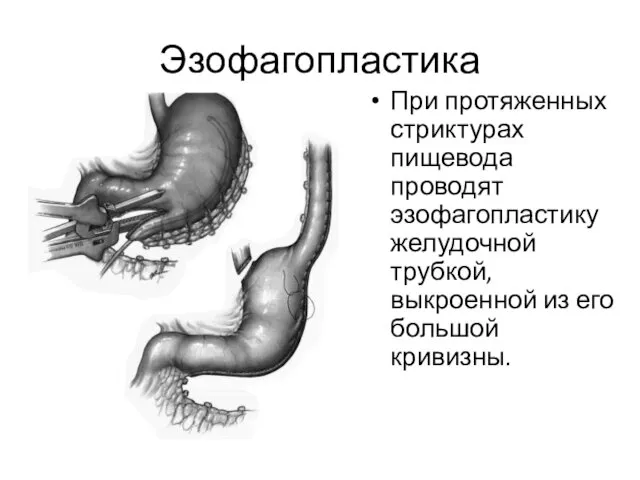 Эзофагопластика При протяженных стриктурах пищевода проводят эзофагопластику желудочной трубкой, выкроенной из его большой кривизны.