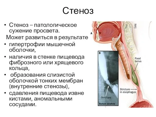 Стеноз Стеноз – патологическое сужение просвета. Может развиться в результате: