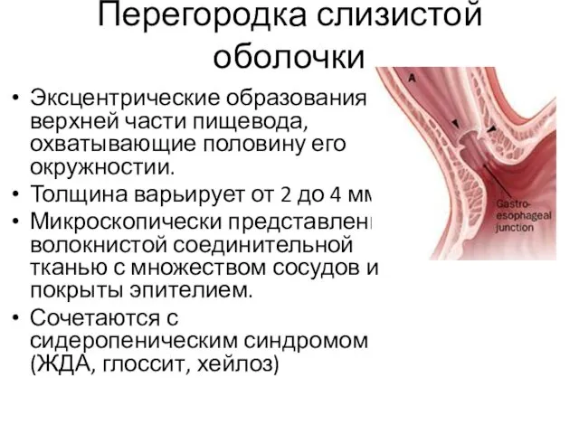 Перегородка слизистой оболочки Эксцентрические образования в верхней части пищевода, охватывающие