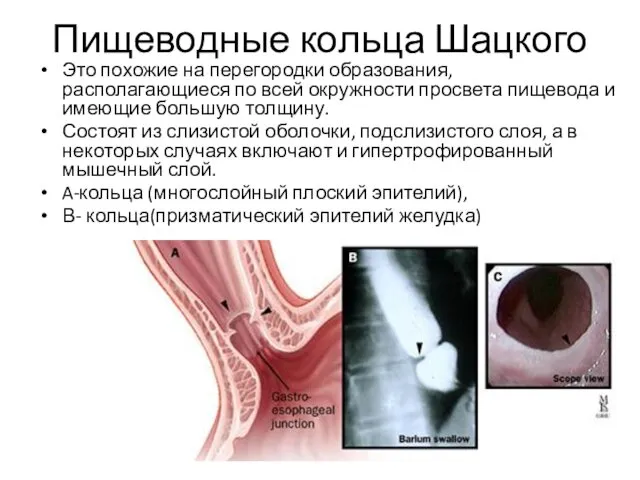 Пищеводные кольца Шацкого Это похожие на перегородки образования, располагающиеся по