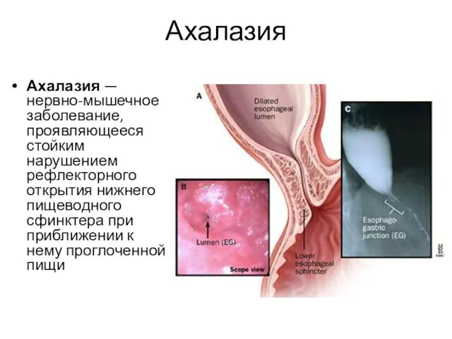 Ахалазия Ахалазия — нервно-мышечное заболевание, проявляющееся стойким нарушением рефлекторного открытия