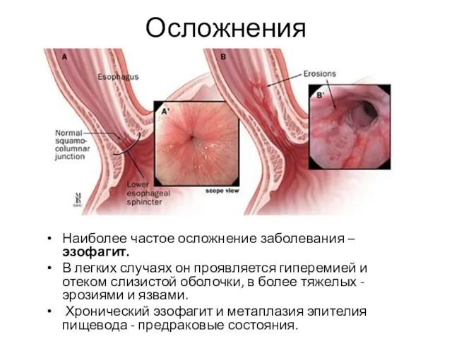 Осложнения Наиболее частое осложнение заболевания – эзофагит. В легких случаях