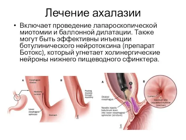 Лечение ахалазии Включает проведение лапароскопической миотомии и баллонной дилатации. Также