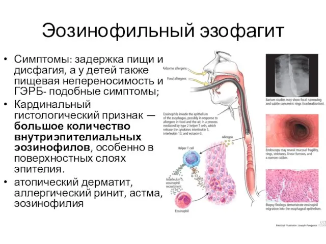 Эозинофильный эзофагит Симптомы: задержка пищи и дисфагия, а у детей