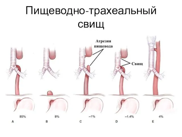 Пищеводно-трахеальный свищ