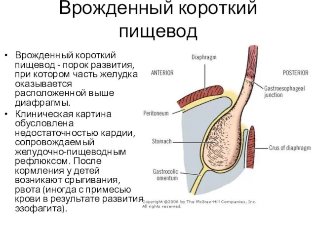 Врожденный короткий пищевод Врожденный короткий пищевод - порок развития, при котором часть желудка