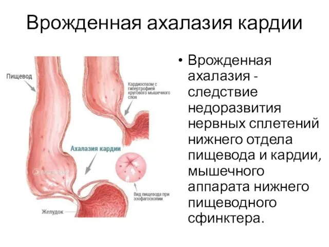 Врожденная ахалазия кардии Врожденная ахалазия - следствие недоразвития нервных сплетений