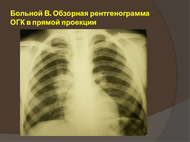 Больной В. Обзорная рентгенограмма ОГК в прямой проекции