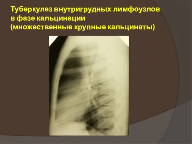 Туберкулез внутригрудных лимфоузлов в фазе кальцинации (множественные крупные кальцинаты)